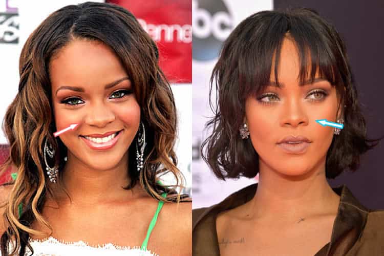 Has Rihanna Had Plastic Surgery? (Before & After Photos 2018)