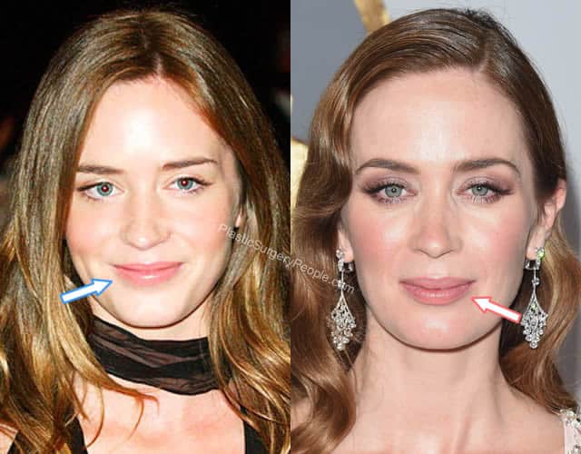 Did Emily Blunt Have Plastic Surgery Before After