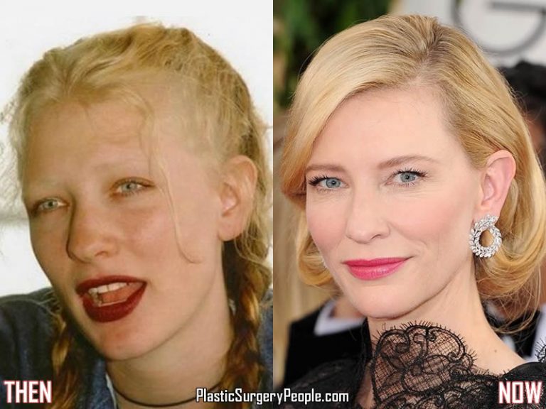 Has Cate Blanchett ever had plastic surgery?