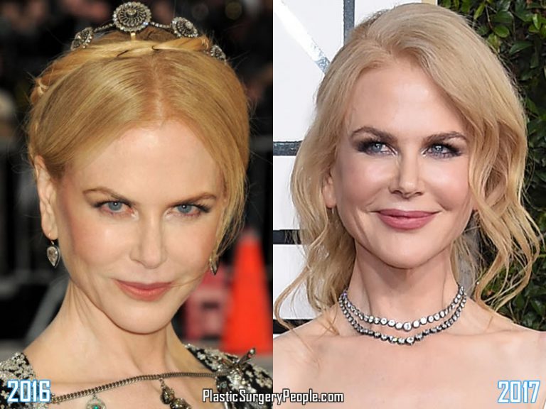 Did Nicole Kidman Have Facelift & Lip Augmentation?