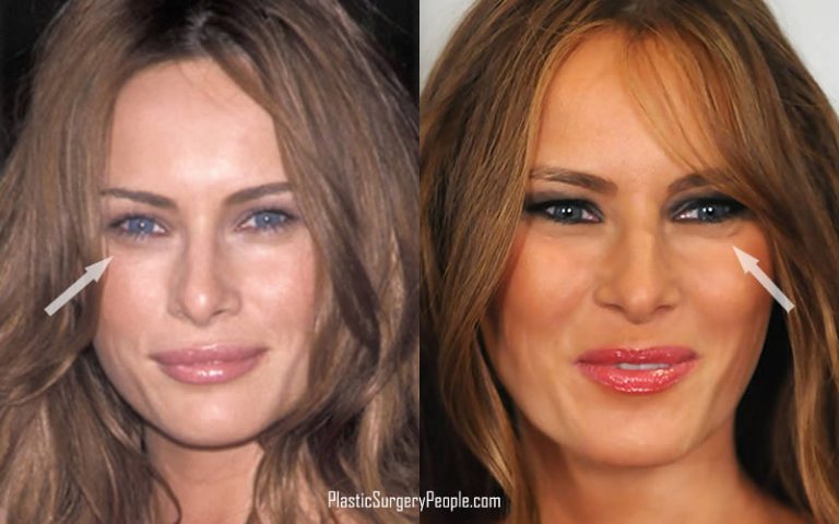 Did Melania Trump Have Plastic Surgery Before She Became FLOTUS?