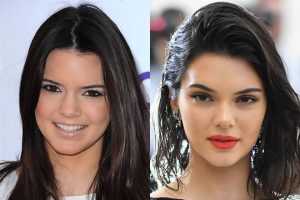 Kendall Jenner, Lip Injections & Plastic Surgery?