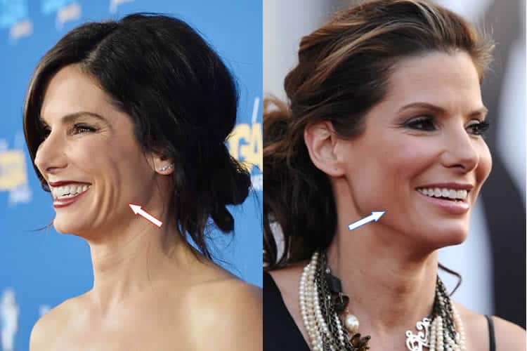 Has Sandra Bullock Had Plastic Surgery Before After Photos