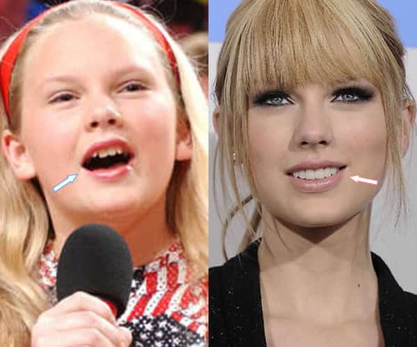 Did Taylor Swift Get Plastic Surgery? (Before & After Photos)