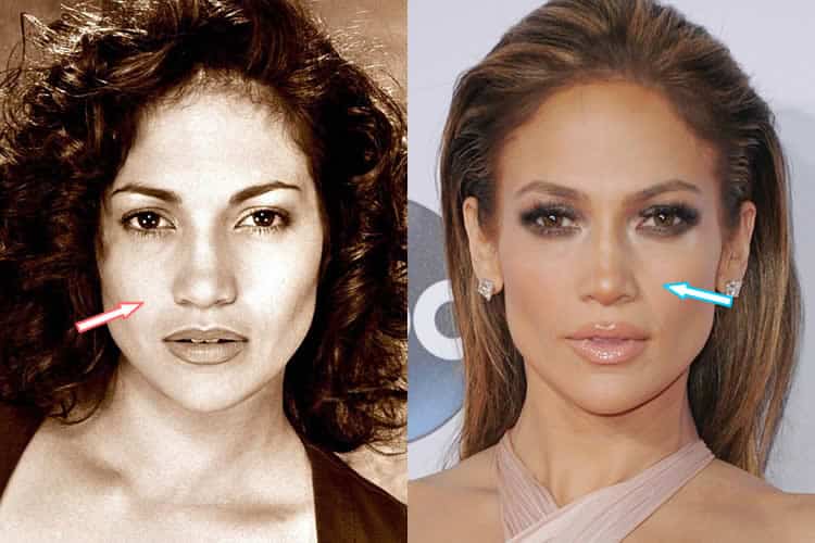 free jennifer lopez plastic surgery