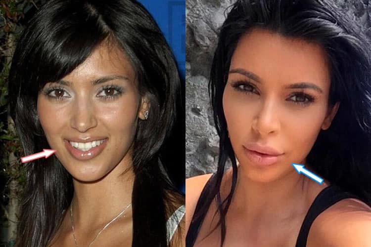 Kim Kardashian Before And After Lip Injections