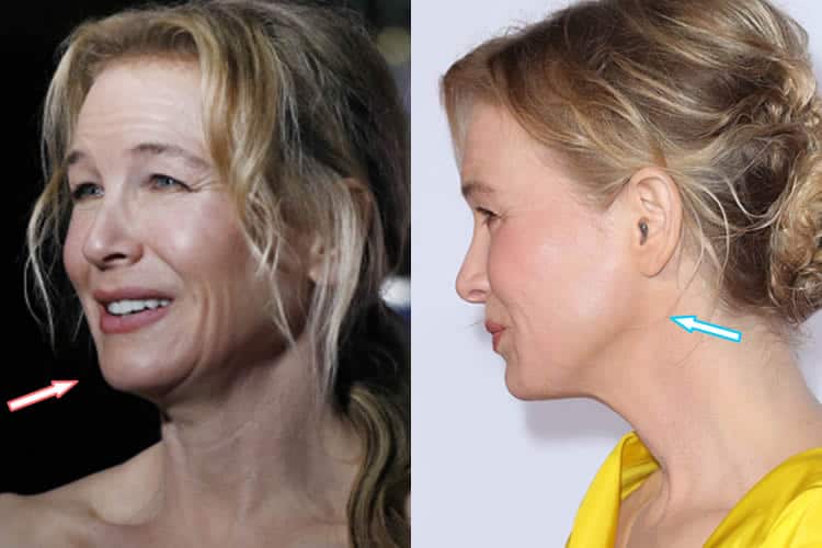Renee Zellweger Plastic Surgery REVEALED? (Before & After ...
