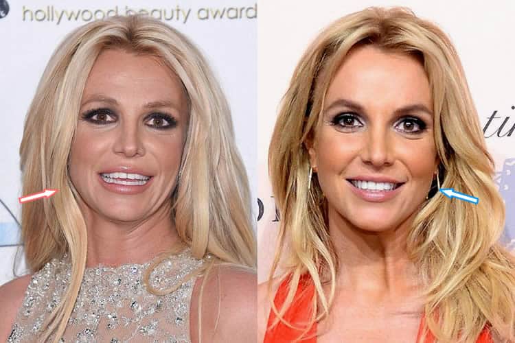 Did Britney Spears Have Cosmetic Surgery Before After