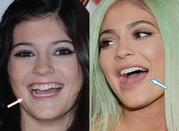 Kylie Jenner Before And After Transformation