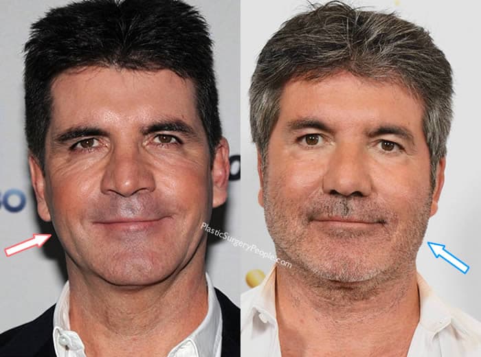 What Has Simon Cowell Done To His Face?