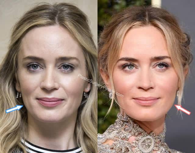 Did Emily Blunt Have Plastic Surgery? (Before & After 2022)