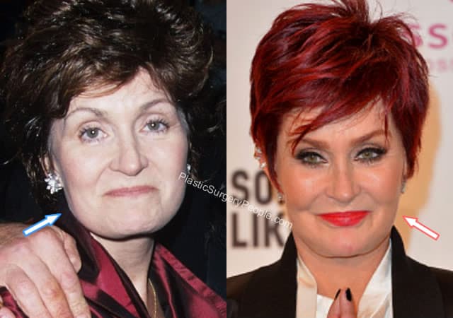 Sharon Osbourne: BEFORE And AFTER