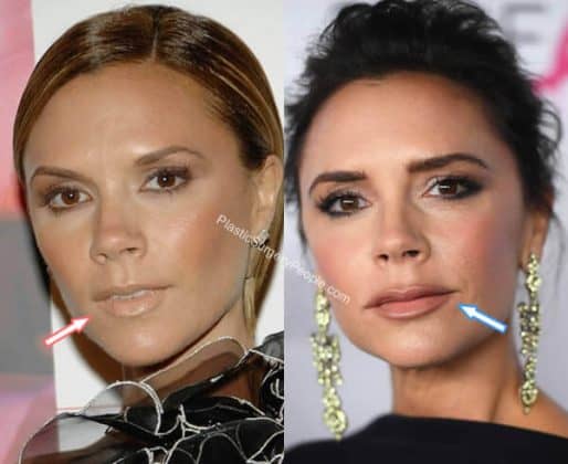 Victoria Beckham, BEFORE And AFTER 2022