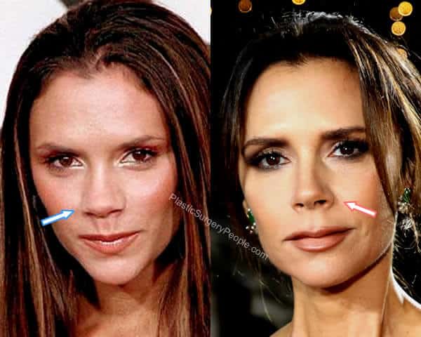 Victoria Beckham, BEFORE And AFTER 2022