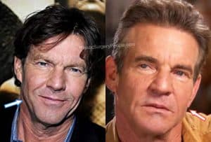 Dennis Quaid: BEFORE and AFTER 2022